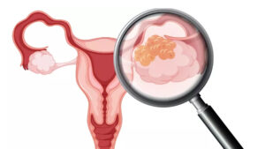 Waspada Kanker Serviks! Dokter Ingatkan Pentingnya Vaksinasi HPV Sejak Dini